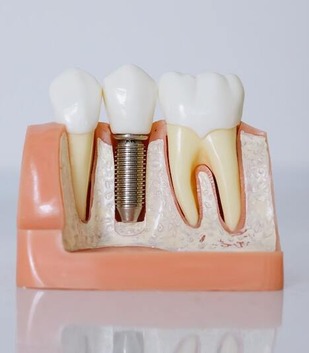 Dental Implant Cross-section Dental implant fixture