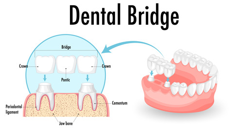 Dental bridge illustration illustration of a dental bridge
