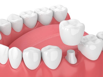 dental crown restoration how a dental crown works