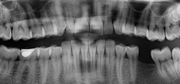 teeth x-ray dental x-ray of teeth
