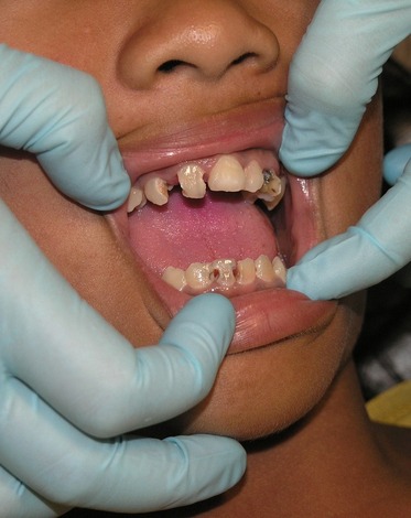 bad teeth teeth getting prosthodontic treatment