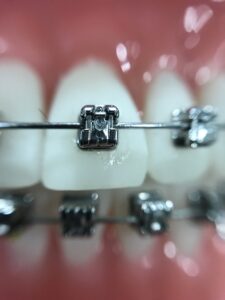 braces braces on teeth