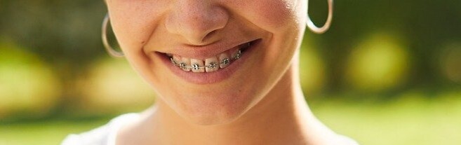 braces on teeth Girl with orthodontic braces on her teeth smiling