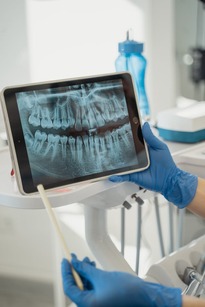 teeth grinding x-ray teeth grinding x-ray on a tablet