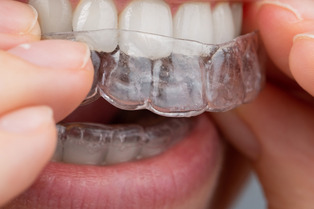 placing invisalign braces on teeth
